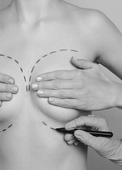 Chirurgie plastică sâni